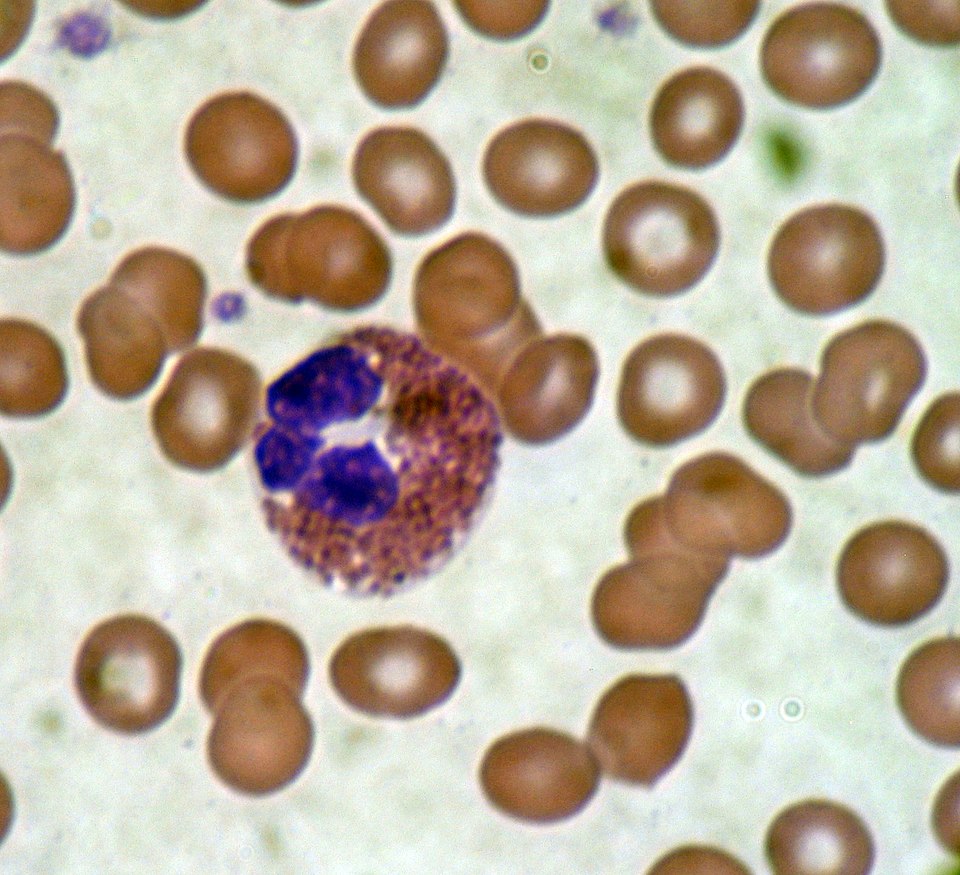 Eosinophil in a peripheral blood smear, Giemsa stain. The bilobed nucleus and large brick-red granules packed with major basic protein are the defining features.