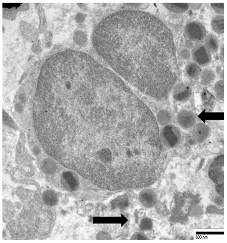 Transmission electron micrograph showing eosinophil cytolytic degranulation: free extracellular granules with intact crystalloid cores, released by cell lysis rather than classical exocytosis.