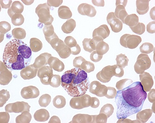 Activated eosinophils in idiopathic hypereosinophilic syndrome. Degranulated cells with vacuolated cytoplasm; some show extracellular granule deposits, a hallmark of cytolytic degranulation.