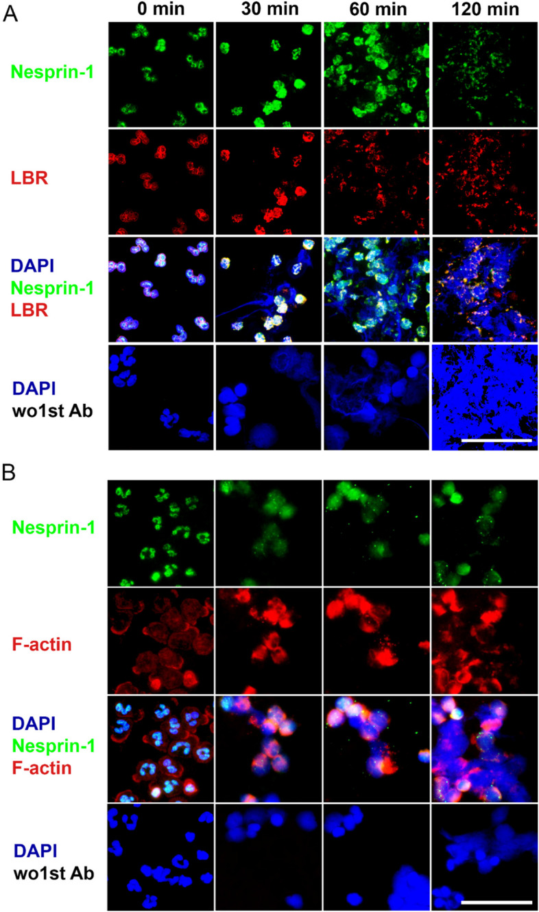 Immunofluorescence of NETs: neutrophils (blue DAPI nuclei) releasing decondensed chromatin co-stained with MPO (red) and citrullinated histone H3 (green).