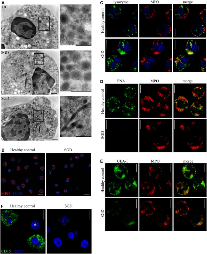 Immunoelectron micrograph of a neutrophil granule showing immunogold labeling of specific granule contents. Granule populations are distinguished by their electron density and marker proteins.